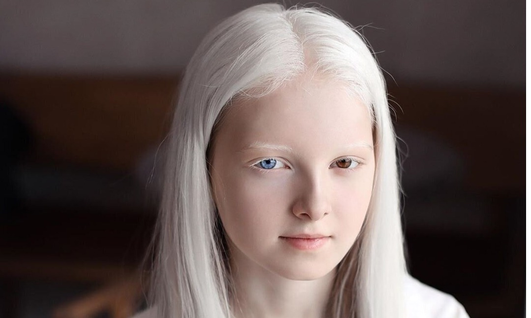 Albino Hastalığı Nedir