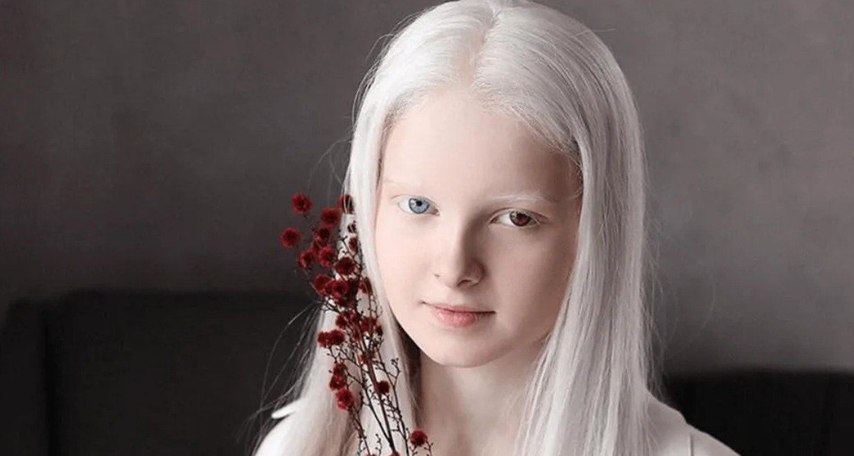 Albino Hastalığı Nedir2